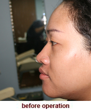 plastic_surgery_augmentation_rhinoplasty